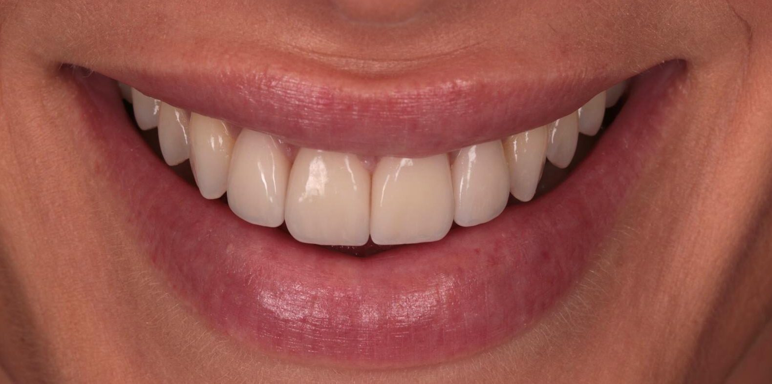 Carillas sonrisa